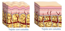 cel·lulitis